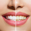 Professional Teeth Whitening